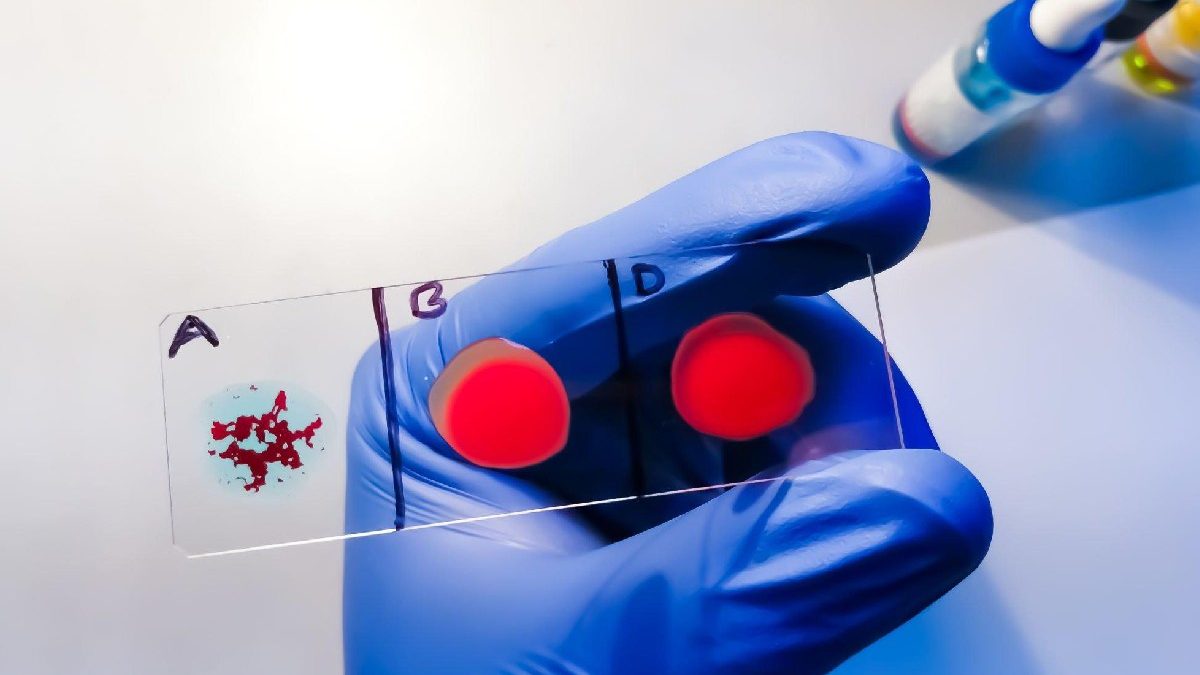 Emm negative rare blood group found in rajkot man 11th such case worldwide